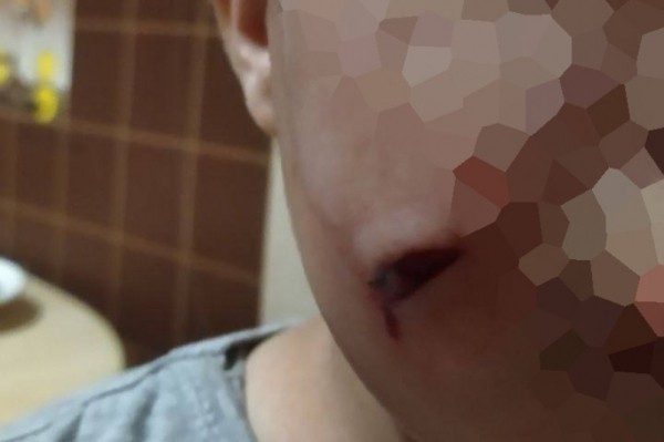 Едва не лишился глаза: бездомный пес прокусил мальчику щеку в Хабаровске