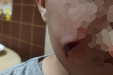 Итоги дня: Кравчук отстранил заммэра, снова на все 100, пес прокусил щеку ребенку